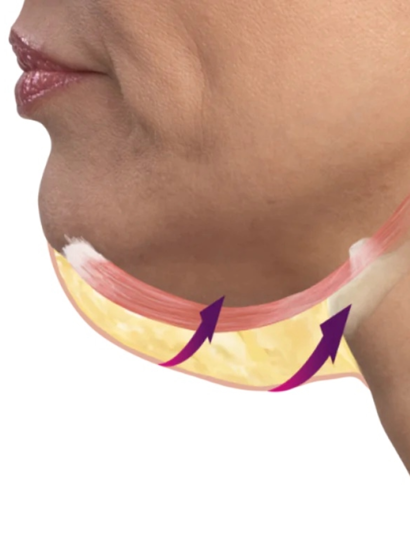  BREAKING NEWS! EMFACE SUBMENTUM: A Revolutionary Solution for Stubborn Double Chin Fat.