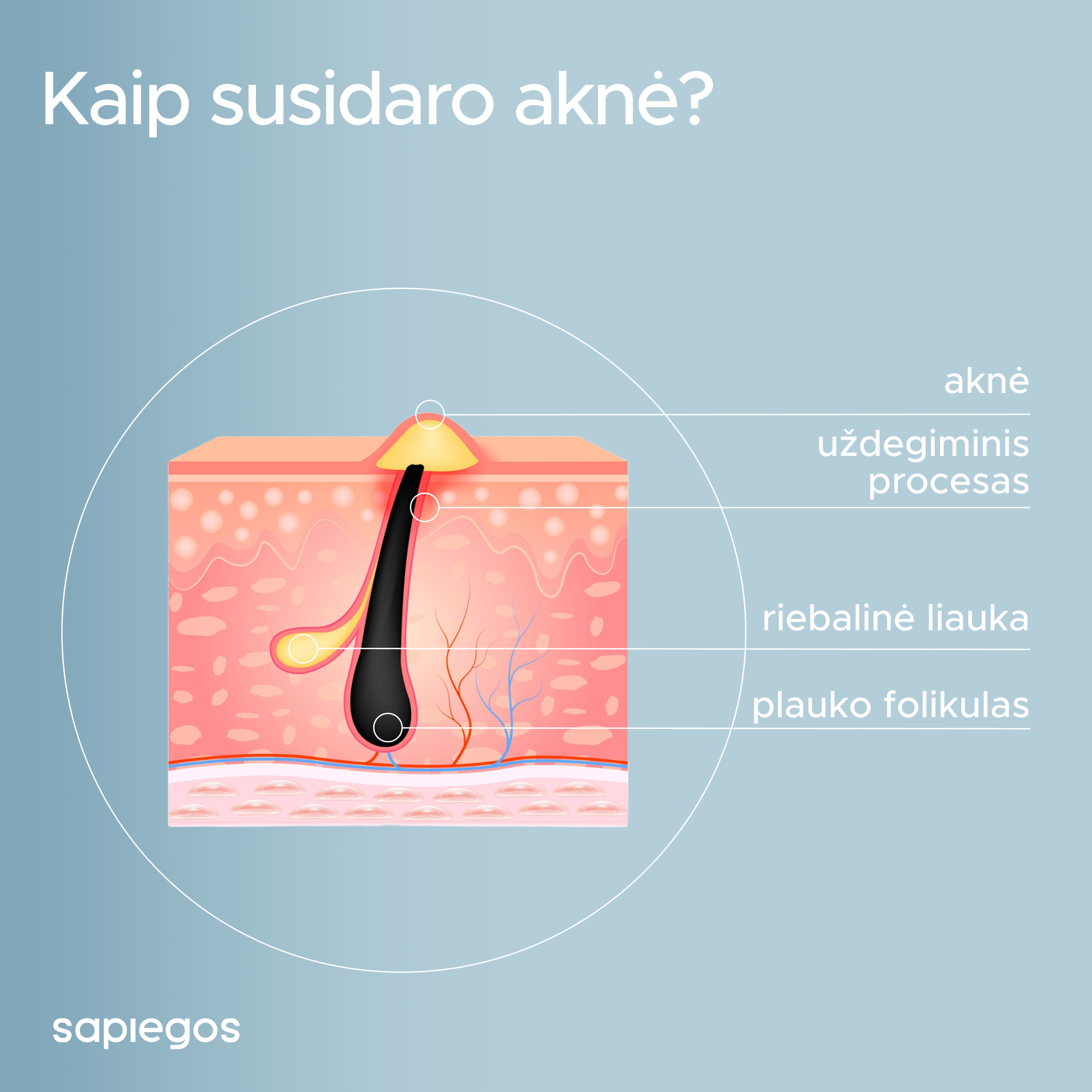 AKNĖ | kas tai? Atsako gyd. dermatologas